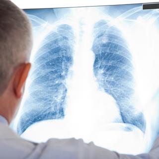 Le cancer du poumon tue 3'200 personnes chaque année en Suisse.
minervastock
Depositphotos [minervastock]