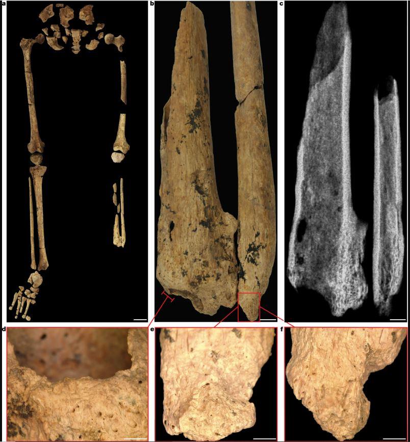 (a) Jambes gauche et droite avec ceinture pelvienne, montrant l'absence complète du tiers distal de la jambe gauche. (b) Tibia et péroné gauches montrant la surface d'amputation, l'atrophie et la nécrose. La surface osseuse est plus poreuse en raison de la lyse qui s'est produite pour éliminer l'os mort (nécrose). (c) Radiographie du tibia et du péroné gauches. (d-f) Os remodelé recouvrant les surfaces d'amputation, démontrant la guérison après l'amputation. (d-e) aspect médial du tibia gauche. (f) aspect antérieur du péroné gauche. [Nature - Tim Ryan Maloney et al.]