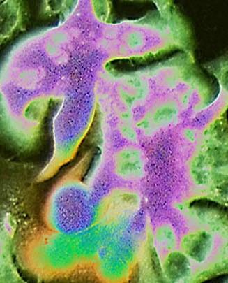 Photomicrographie d'une co-culture cellulaire de PAME pro-métastatiques du cancer primaire du côlon (violet) mélangées à des PIM migratoires induites (vert). [UNIGE - Ariel Ruiz i Altaba]