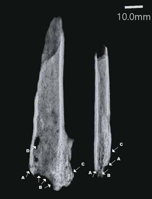 Radiographie du membre amputé: le tibia, à gauche et le péroné (placé en position postéro-antérieure). Les flèches montrent (A) des marges de coupe claires indiquant l'utilisation d'un instrument tranchant. (B) Résorption de l'os due à un manque de vascularisation adéquate du tissu osseux. (C) Ossification hétérogène de la membrane interosseuse. (D) Dommages post-mortem causés par des insectes. [Nature - Tim Ryan Maloney et al.]