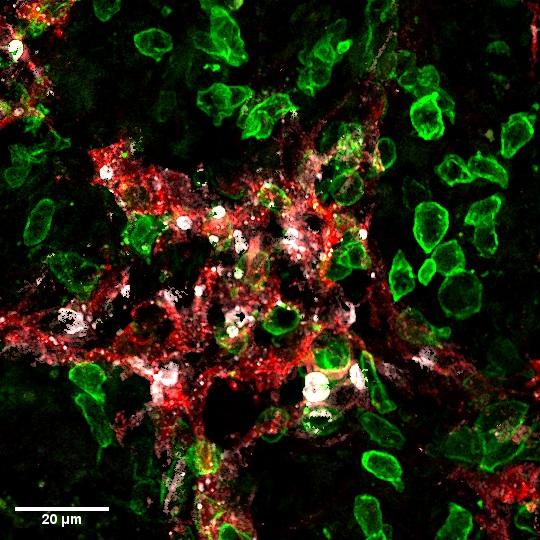 Les lymphocytes tueurs (en vert) attaquent les vaisseaux lymphatiques (en rouge) dans la tumeur, et entraînent leur mort (marqueur de mort cellulaire en blanc).
Stéphanie Hugues
Unige 2022 [Unige 2022 - Stéphanie Hugues]