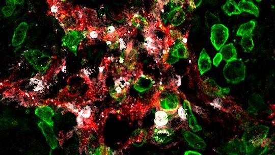 Les lymphocytes tueurs (en vert) attaquent les vaisseaux lymphatiques (en rouge) dans la tumeur, et entraînent leur mort (marqueur de mort cellulaire en blanc).
Stéphanie Hugues
Unige 2022 [Unige 2022 - Stéphanie Hugues]