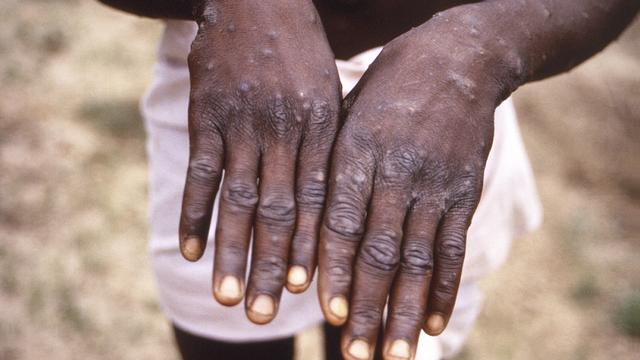 Une image prise en 1997 en République démocratique du Congo montre les surfaces dorsales des mains d'un patient atteint de la variole du singe. 
CDC
Keystone [Keystone - CDC]