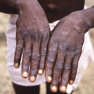 Une image prise en 1997 en République démocratique du Congo montre les surfaces dorsales des mains d'un patient atteint de la variole du singe. 
CDC
Keystone [Keystone - CDC]