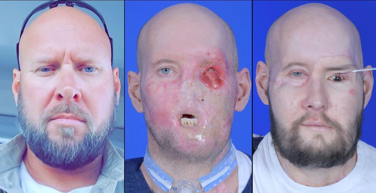 A gauche, Aaron avant son accident. Au milieu, avant la transplantation et à droite, cinq mois après la transplantation. [NYU Langone Health]