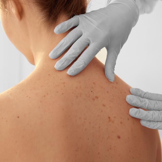 Une patiente se fait examiner par sa dermatologue. En Suisse, les cas de cancers de la peau ont doublé ces 30 dernières années. [Depositphotos - Belchonock]