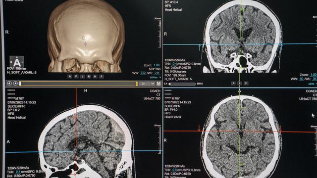 Rendre la parole à ceux qui en ont perdu l'usage à cause d'une maladie ou d'un accident devient de plus en plus plausible. (image d'illustration) [NURPHOTO VIA AFP - VERNON YUEN]