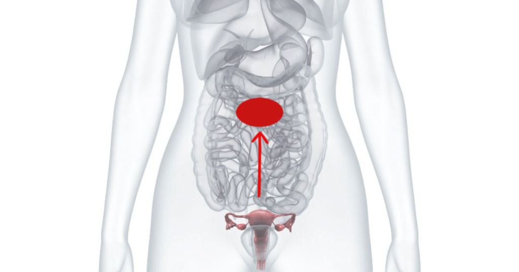 L'utérus et les ovaires sont déplacés provisoirement dans la partie supérieure de l'abdomen. [Hôpital du Valais]