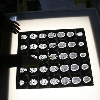Une radiographie du cerveau d'un patient. [Reuters - Rupak De Chowdhuri]