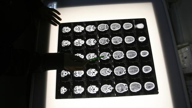 Une radiographie du cerveau d'un patient. [Reuters - Rupak De Chowdhuri]