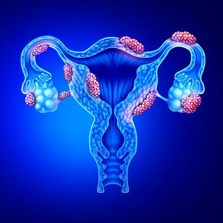 Illustration 3D d'un utérus et d'ovaires atteints d'endométriose. [Depositphotos - Lightsource]