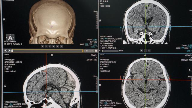 Le secret mental menacé par les implants cérébraux et l'IA, avertit l'UNESCO. [NURPHOTO VIA AFP - VERNON YUEN]