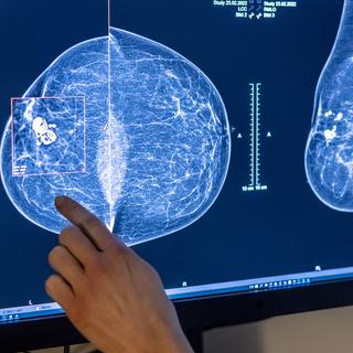 Cancer du sein, une approche plus égalitaire permettrait de sauver des femmes. [Keystone - Hannibal Hanschke]