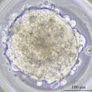 Sphéroïdes de tumeur pulmonaire d'origine humaine. [HUG - UNIGE - ©Véronique Serre-Beinier]