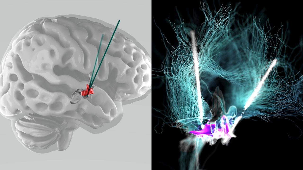 Représentation visuelle de la stimulation cérébrale profonde de l'hypothalamus latéral dans l'étude de .NeuroRestore à l'EPFL. [.NeuroRestore / EPFL 2024 - CC BY-SA 4.0]