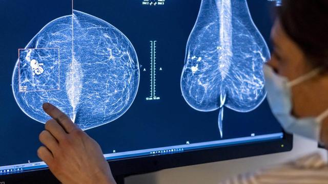 Les programmes de dépistage du cancer du sein varient d'un canton à l'autre, selon une étude. [Keystone]