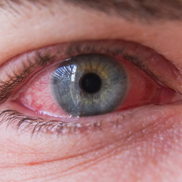 La conjonctivite est une inflammation de la membrane qui recouvre l'œil. [Depositphotos - amphoto]