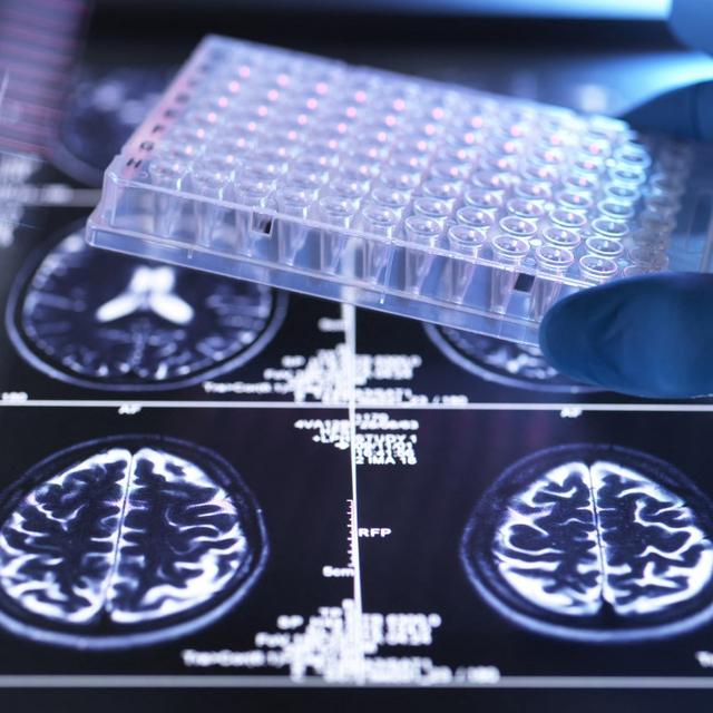 Scans d'un cerveau. [AFP - TEK IMAGE / SCIENCE PHOTO LIBRARY / ABO]