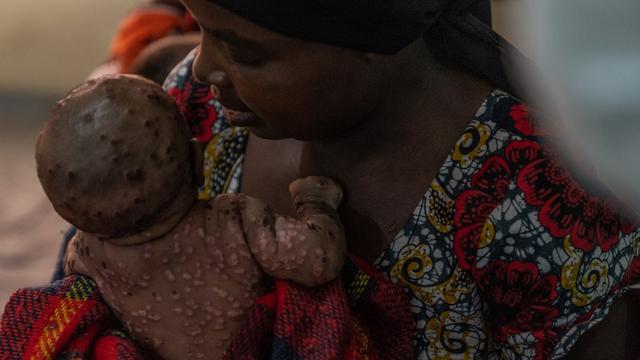 Une femme prend soin de son enfant atteint d'une forme sévère de Mpox au Centre hospitalier de Kavumu en République démocratique du Congo (24.08.24). [AFP - GLODY MURHABAZI]