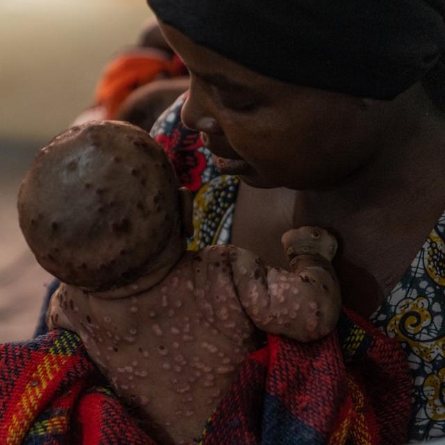 Une femme prend soin de son enfant atteint d'une forme sévère de Mpox au Centre hospitalier de Kavumu en République démocratique du Congo (24.08.24). [AFP - GLODY MURHABAZI]