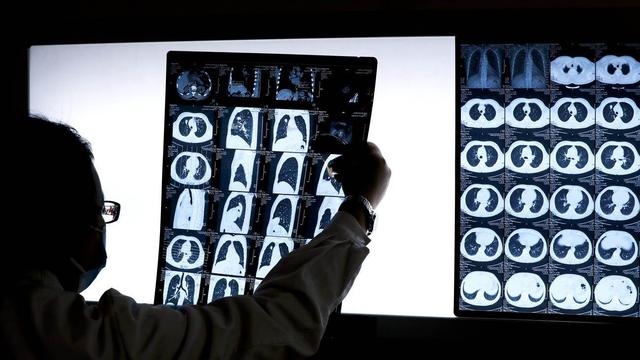 Le cancer a affecté environ 20 millions de personnes supplémentaires en 2022 et provoqué neuf millions de décès la même année, selon une entité de l'OMS. [Keystone]