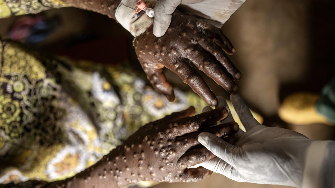 Une première livraison de près de 100'000 doses de vaccins contre le mpox est attendue jeudi en RDC. [KEYSTONE - EPA/MICHAEL LUNANGA]