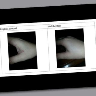 L'implant d'une micro-puce NFC dans la main de Seth Whales [Seth Whales]
