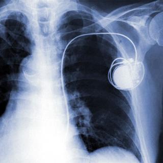 Dans le futur, les pacemakers artificiels devraient être remplacés par des techniques biologiques.
Khuruzero
Fotolia [Khuruzero]