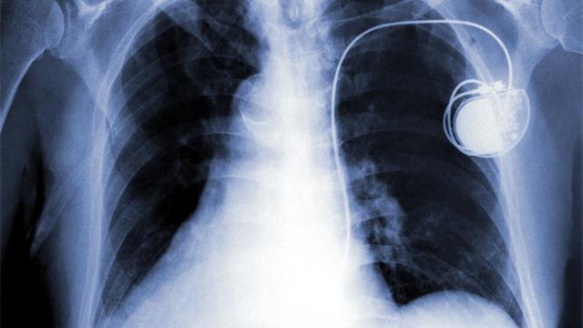 Dans le futur, les pacemakers artificiels devraient être remplacés par des techniques biologiques.
Khuruzero
Fotolia [Khuruzero]