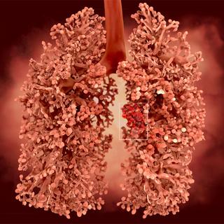 Le cancer du poumon peut être dû à une exposition à l'amiante.
Juan Gärtner
Fotolia [Juan Gärtner]