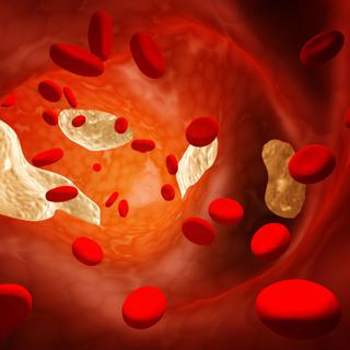 Une thrombose veineuse est une formation d'un caillot de sang dans une veine.
Frenta
Fotolia [Frenta]