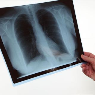 La tuberculose est causée par une bactérie qui touche le plus souvent les poumons.
Dominique Vernier
Fotolia [Fotolia - Dominique Vernier]
