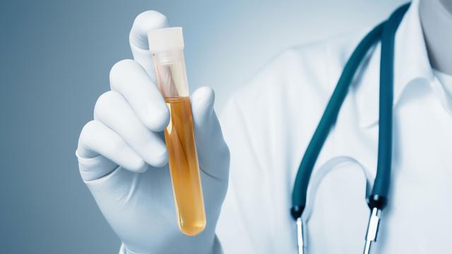 L'urine est une importante source d'informations médicales.
Von Schonertagen
Fotolia [Von Schonertagen]