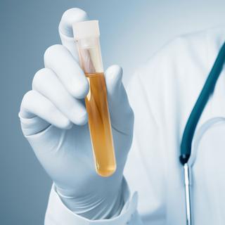 L'urine est une importante source d'informations médicales.
Von Schonertagen
Fotolia [Von Schonertagen]