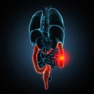 L'inflammation due à la maladie de Crohn peut toucher n'importe quelle partie du tube digestif.
unlimit3d
Fotolia [Fotolia - unlimit3d]