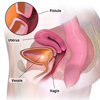 Fistule [Own work - BruceBlaus]