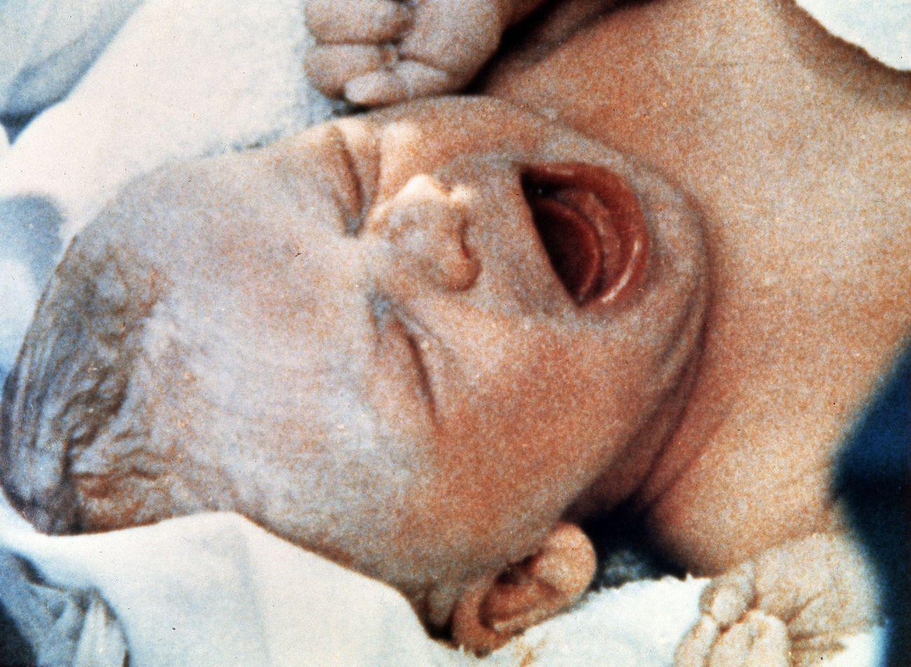 Louise Brown, le premier "bébé-éprouvette", est née le 25 juillet 1978 en Angleterre.AP/STRKeystone [AP/STR]