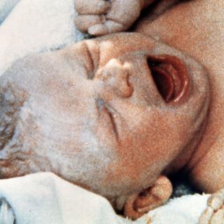 Louise Brown, le premier "bébé-éprouvette", est née le 25 juillet 1978 en Angleterre.
AP/STR
Keystone [AP/STR]