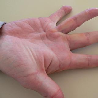 Photo d'une main atteinte de la Maladie de Dupuytren. [Wikicommons - Frank C. Müller]