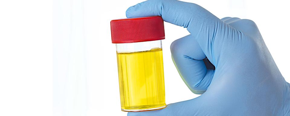 Flacon d'urine (image prétexte). [Fotolia - JPC-PROD]