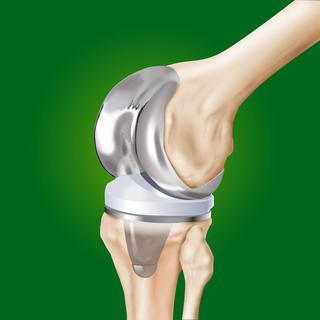 Une prothèse remplace l'articulation lésée du genou. [alexonline]