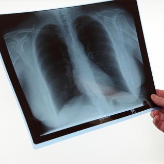 La tuberculose pulmonaire est la forme la plus courante de cette maladie.
dominique vernier
Fotolia [dominique vernier]
