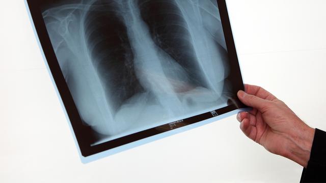 La tuberculose pulmonaire est la forme la plus courante de cette maladie.
dominique vernier
Fotolia [dominique vernier]