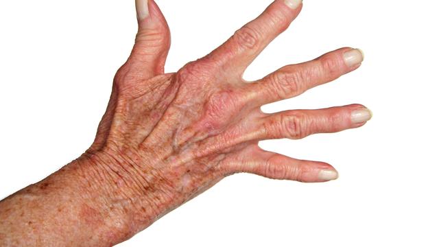 La chirurgie peut-elle soulager l'arthrite de la main? [Peterfactors]