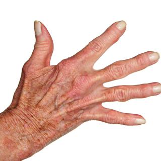 La chirurgie peut-elle soulager l'arthrite de la main? [Peterfactors]