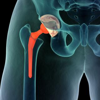 La prothèse de hanche remplace une articulation endommagée. [Fotolia - Anatomy Insider]