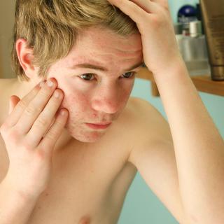L'acné touche 80% des adolescents. [BSIP - Lemoine]