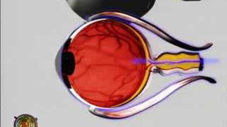 Médecine : l'oeil bionique, un espoir pour les aveugles