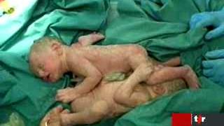 Des pédiatres de l'Hôpital de Zurich parviennent à séparer des siamois unis par le ventre