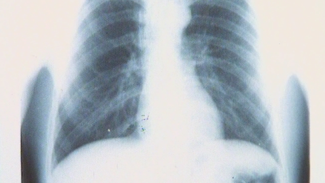 La tuberculose en Suisse. [RTS]